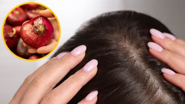 Wcierka z cebuli to najlepszy sposób na porost..